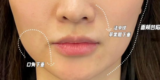 鈦提升可以解決凹陷嗎