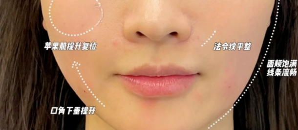 鈦提升打多少焦